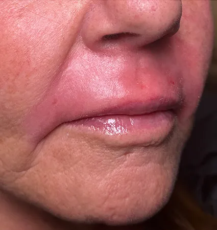 trl-contouring-above-lip-10