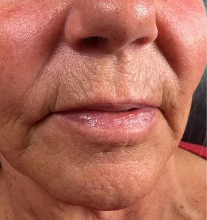 trl-contouring-above-lip-11