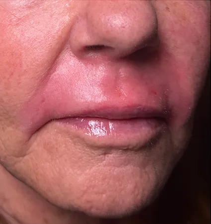 trl-contouring-above-lip-12